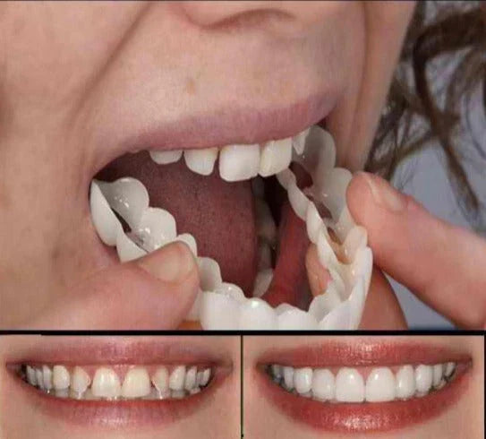FitFlex Snap-On Denture