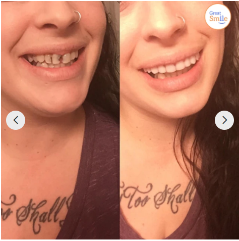 Removable Dentures | Perfect Smile