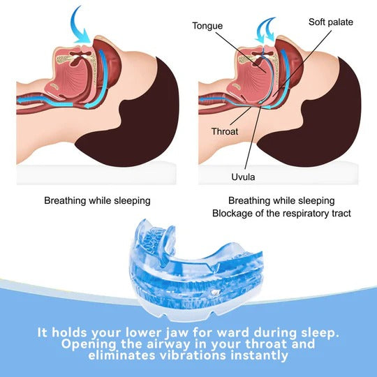 Adjustable Anti-Snoring Mouthpiece with Screw Mechanism – Comfortable Adjustment for Better Sleep Quality