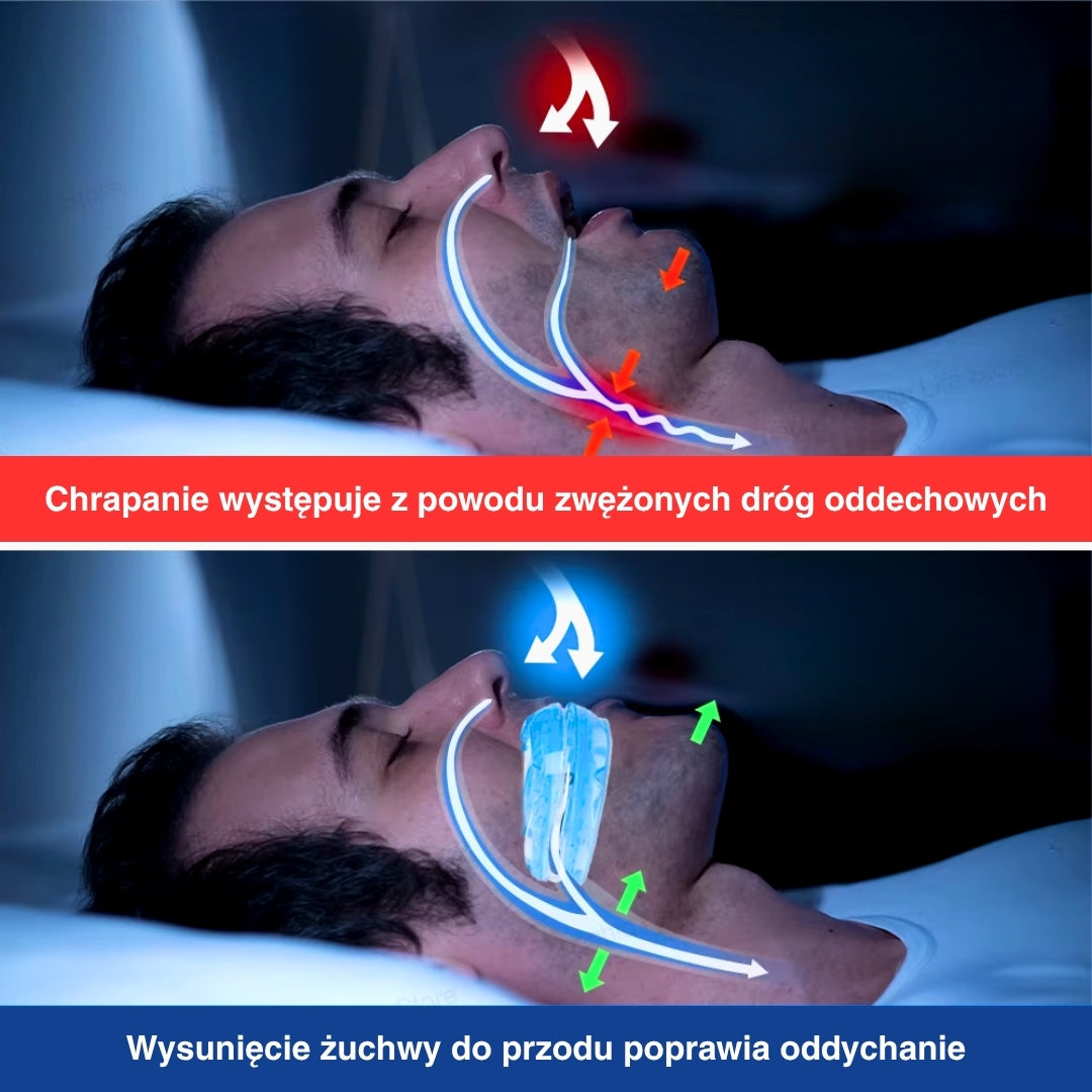 Adjustable Anti-Snoring Mouthpiece with Screw Mechanism – Comfortable Adjustment for Better Sleep Quality