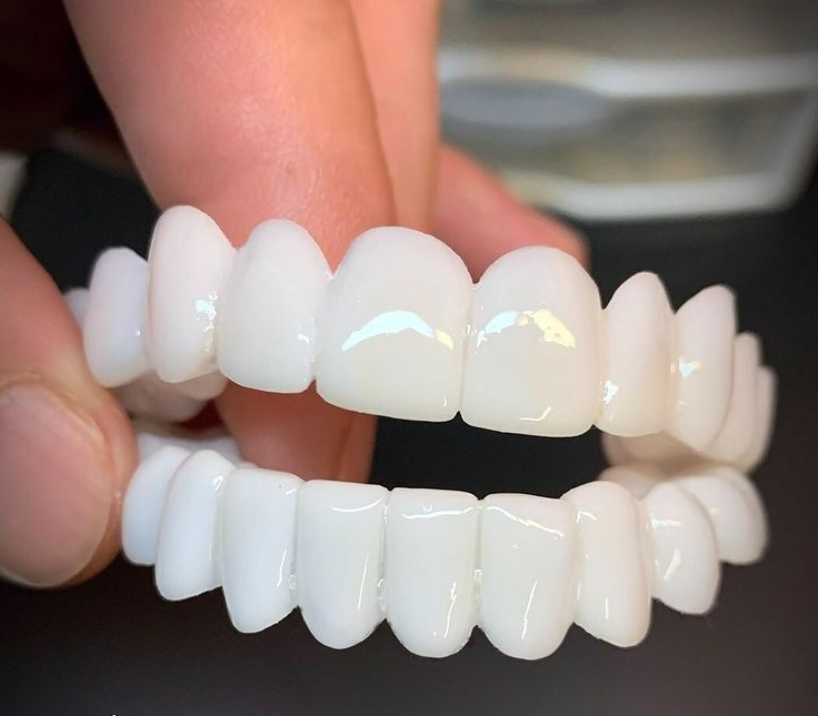 Bella | DentAlign Dental Veneers – Natural Fit and Comfort