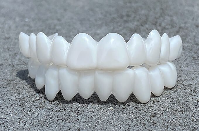 Bella | DentAlign Dental Veneers – Natural Fit and Comfort