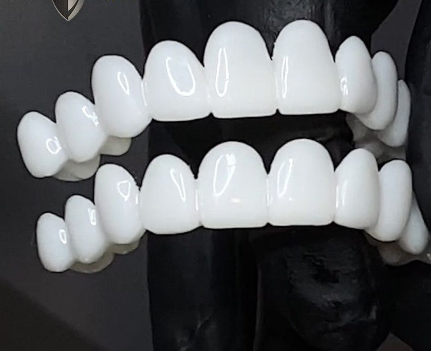 Bella | DentAlign Dental Veneers – Natural Fit and Comfort