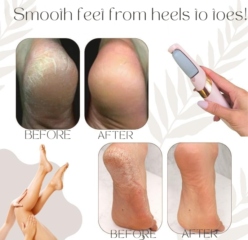 Callus Remover | Quartz Crystal Rollers | Waterproof & Rechargeable | CallusPro