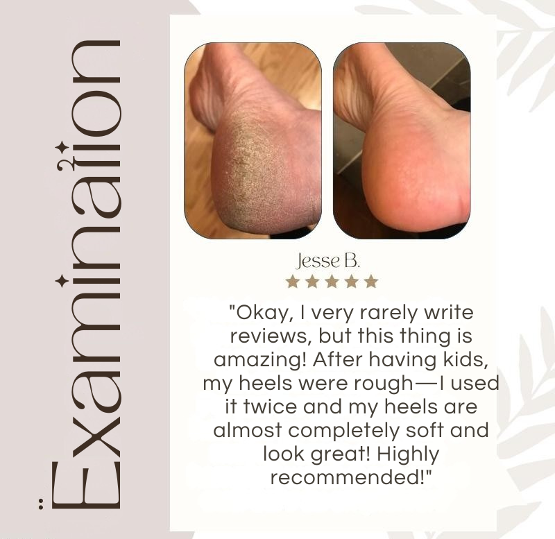 Callus Remover | Quartz Crystal Rollers | Waterproof & Rechargeable | CallusPro