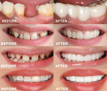 Removable Dentures | Perfect Smile