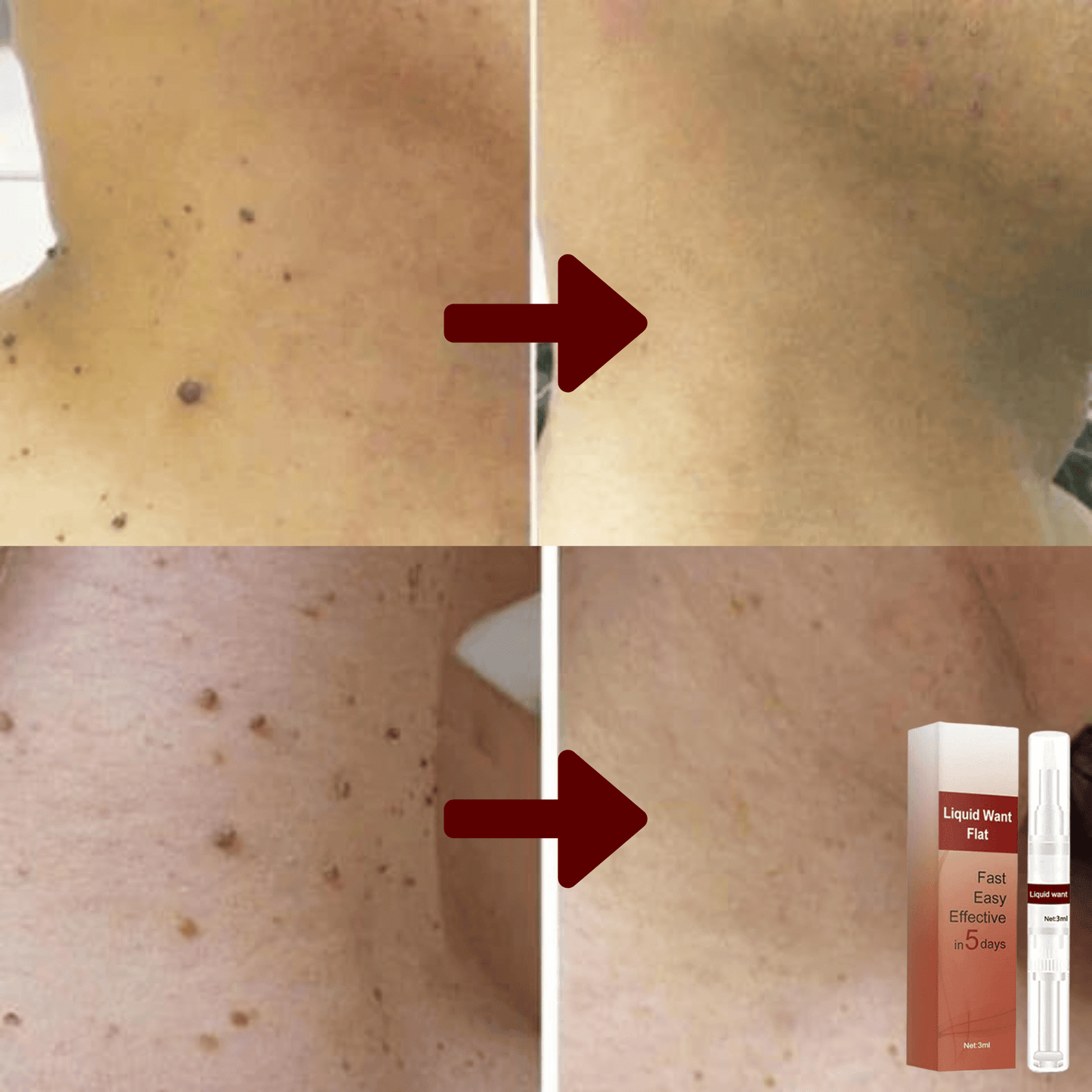 Skin Tag Remover