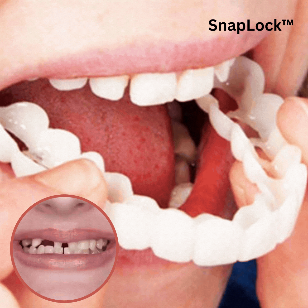 Snap-On Dentures - Perfect Smile