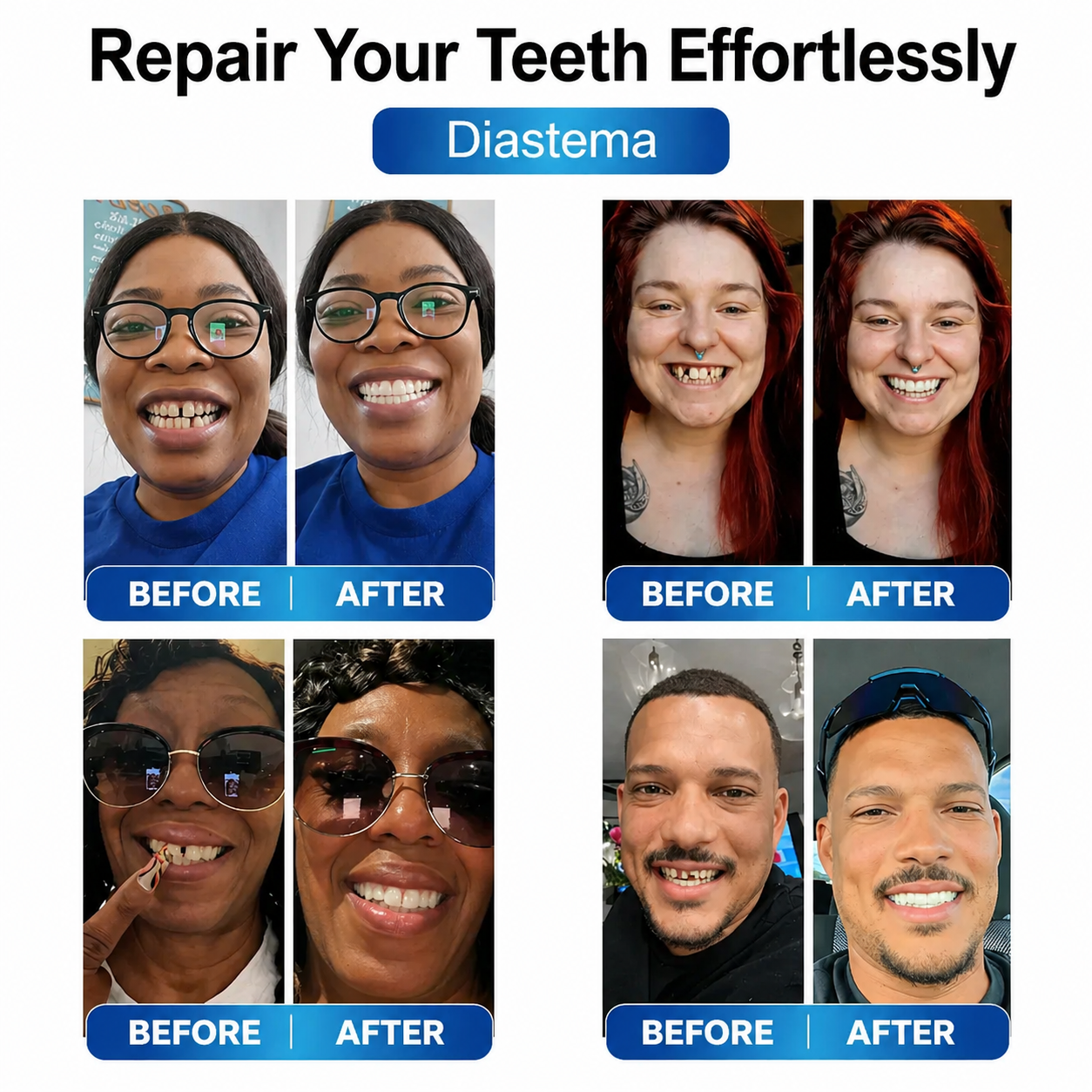 Tooth Repair Kit with LED Light - Moldable Denture Gel - Futusly Dentures